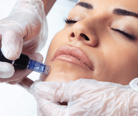 Dermapen: El Poder de la Microperforación