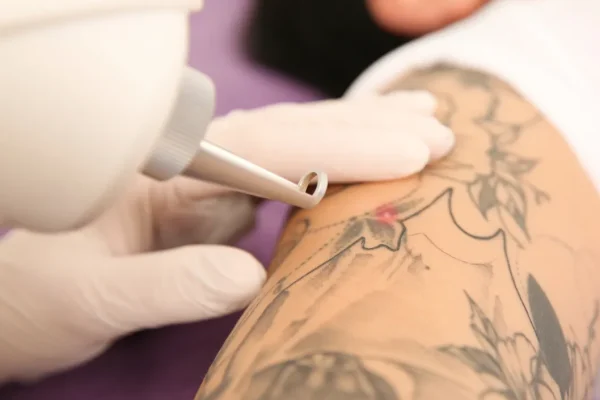 Eliminación de tatuajes en MAdrid